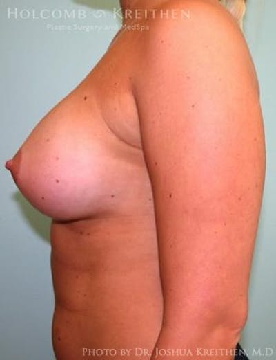 Breast Augmentation Before & After Gallery - Patient 6236568 - Image 6