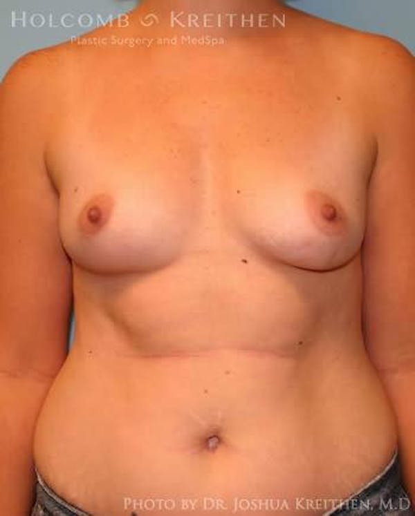 Breast Augmentation Before & After Gallery - Patient 6236569 - Image 1