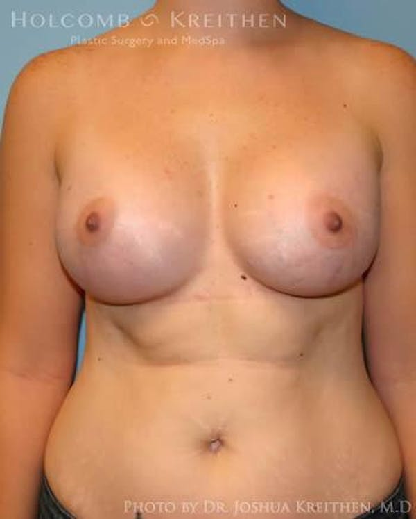 Breast Augmentation Before & After Gallery - Patient 6236569 - Image 2