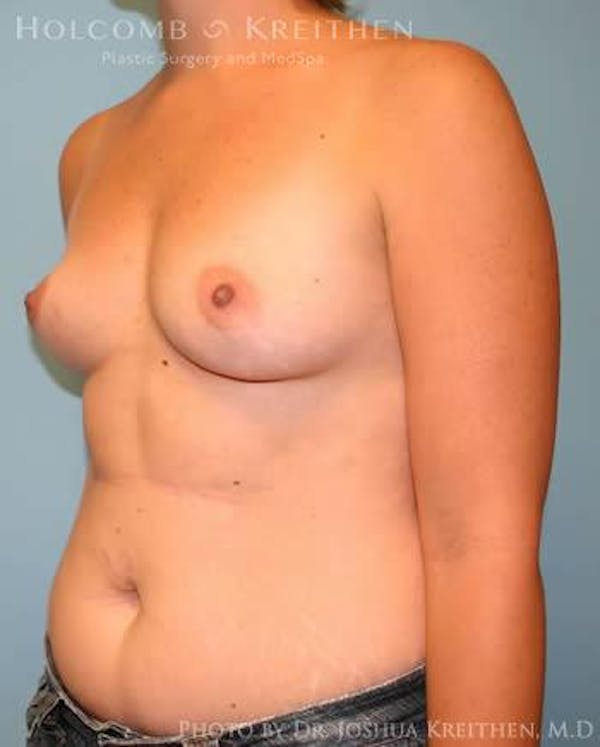 Breast Augmentation Before & After Gallery - Patient 6236569 - Image 3