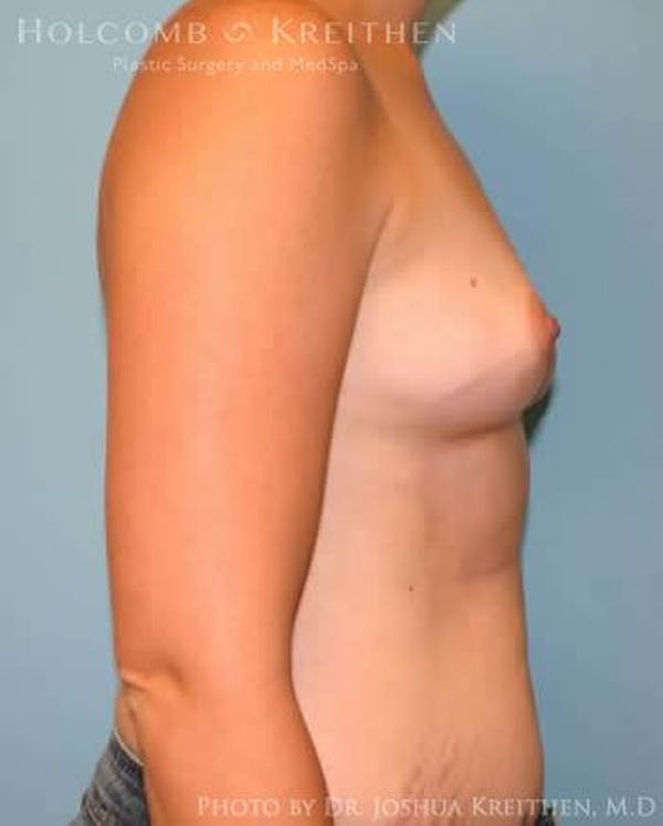 Breast Augmentation Gallery - Patient 6236569 - Image 5