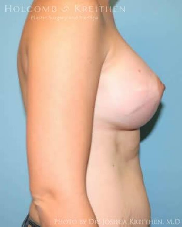 Breast Augmentation Before & After Gallery - Patient 6236569 - Image 6