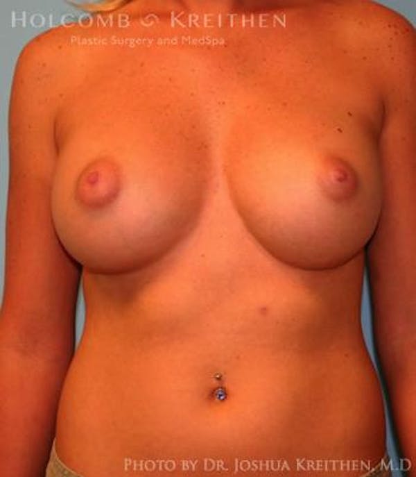 Breast Augmentation Before & After Gallery - Patient 6236580 - Image 2
