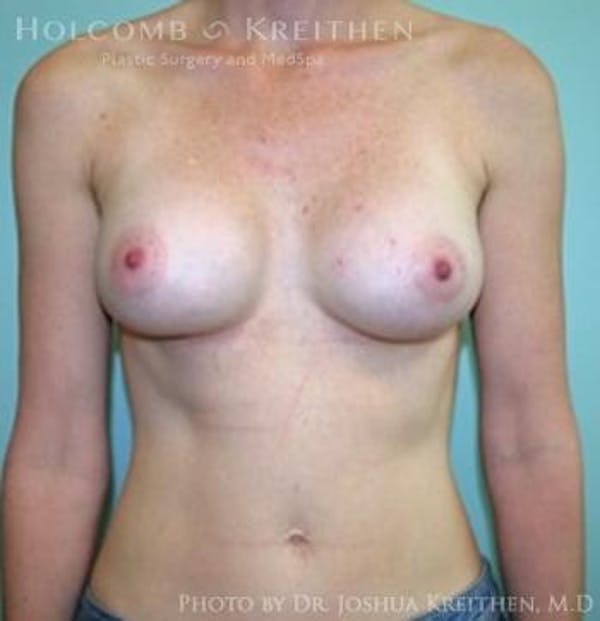 Breast Augmentation Before & After Gallery - Patient 6236582 - Image 1