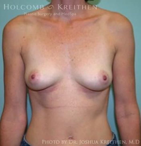 Breast Augmentation Before & After Gallery - Patient 6236582 - Image 1