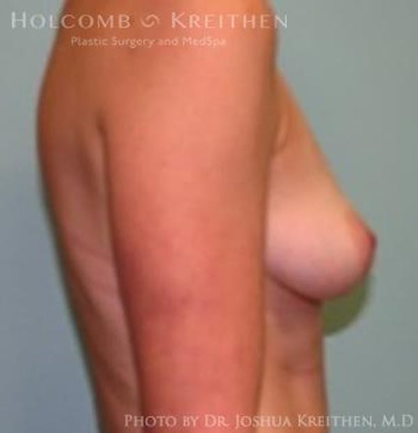 Breast Augmentation Before & After Gallery - Patient 6236582 - Image 5