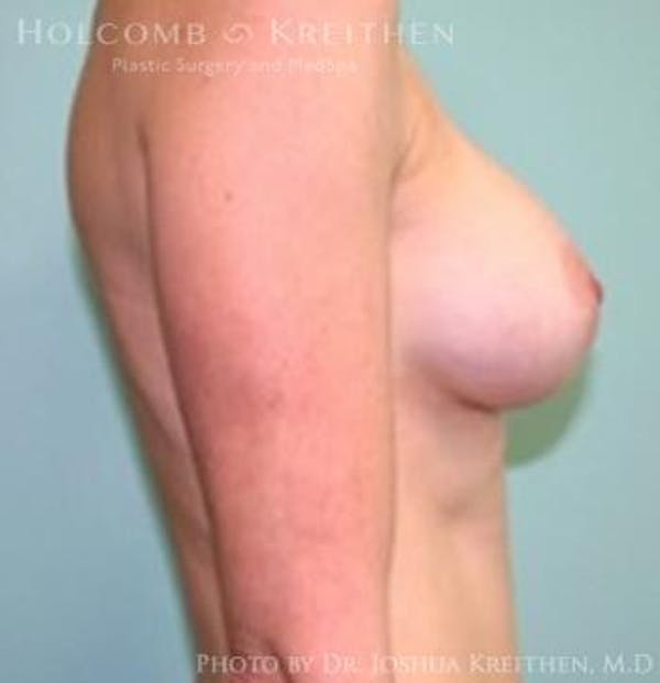 Breast Augmentation Gallery - Patient 6236582 - Image 6