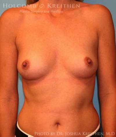 Breast Augmentation Gallery - Patient 6236583 - Image 1