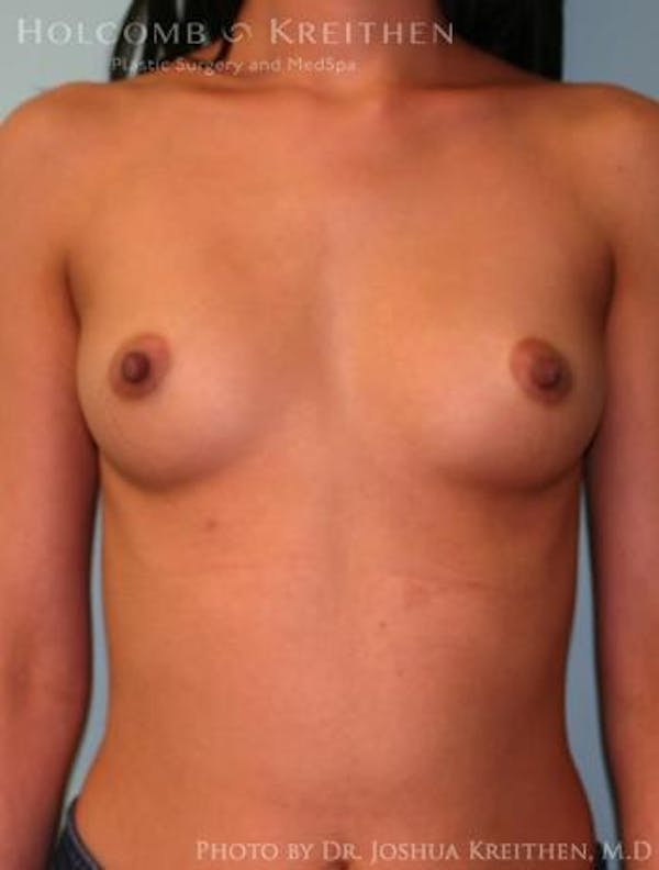 Breast Augmentation Gallery - Patient 6236585 - Image 1