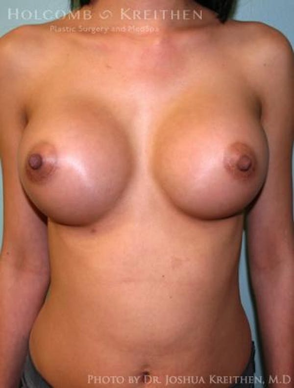 Breast Augmentation Before & After Gallery - Patient 6236585 - Image 2