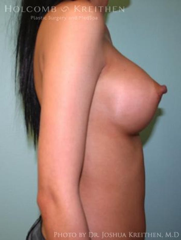 Breast Augmentation Before & After Gallery - Patient 6236585 - Image 6
