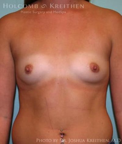Breast Augmentation Before & After Gallery - Patient 6236588 - Image 1