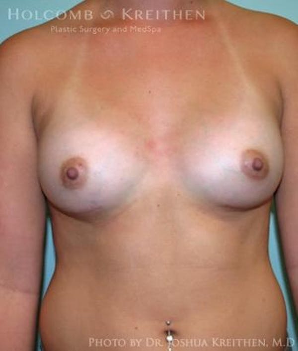 Breast Augmentation Before & After Gallery - Patient 6236588 - Image 2