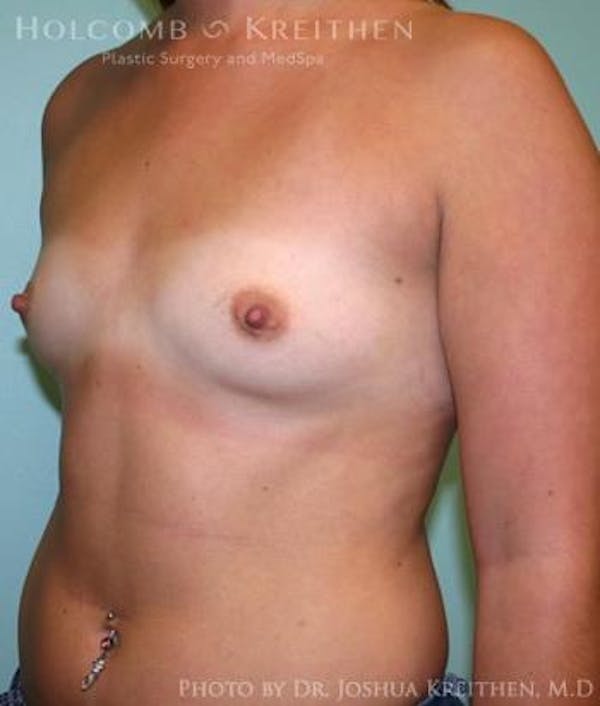 Breast Augmentation Before & After Gallery - Patient 6236588 - Image 3