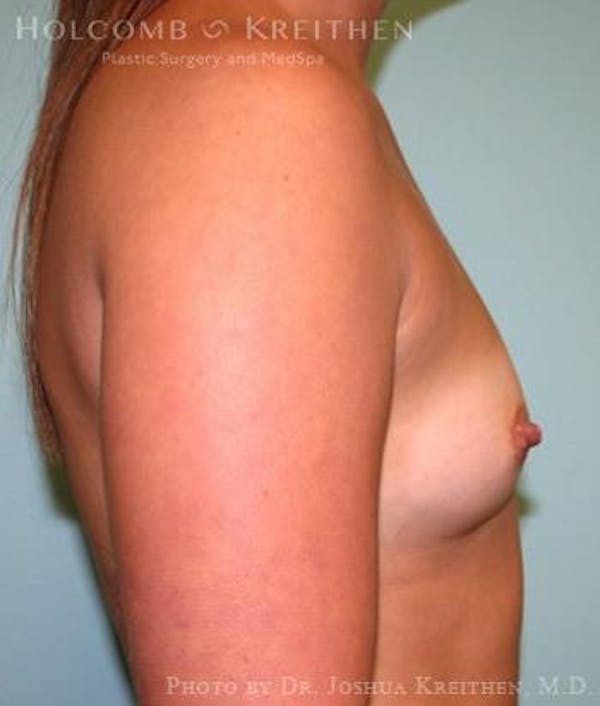 Breast Augmentation Before & After Gallery - Patient 6236588 - Image 5