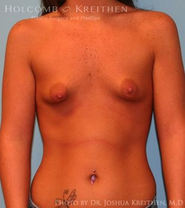 Breast Augmentation Before & After Gallery - Patient 6236589 - Image 1