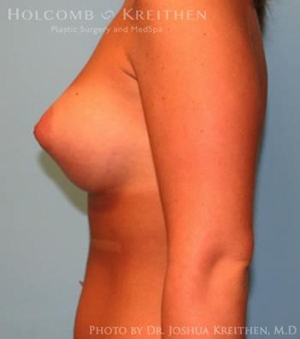 Breast Augmentation Before & After Gallery - Patient 6236589 - Image 6