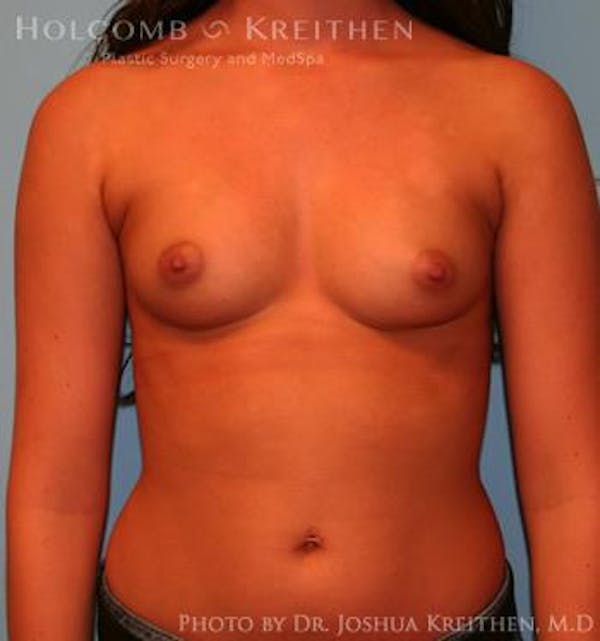 Breast Augmentation Before & After Gallery - Patient 6236590 - Image 1