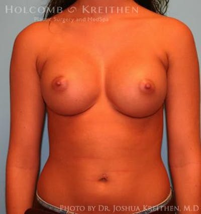 Breast Augmentation Before & After Gallery - Patient 6236590 - Image 2