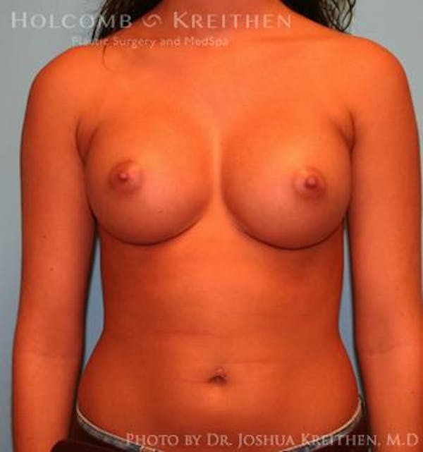 Breast Augmentation Gallery - Patient 6236590 - Image 2