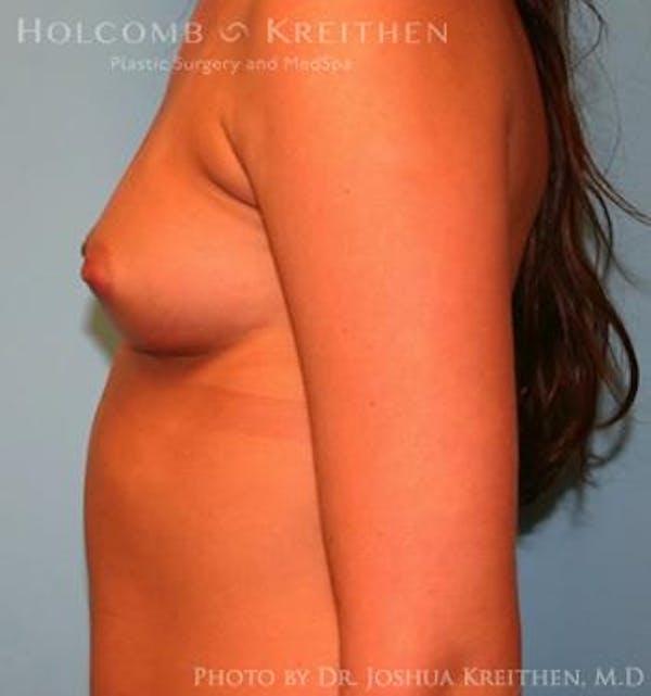 Breast Augmentation Before & After Gallery - Patient 6236590 - Image 5