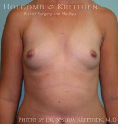 Breast Augmentation Before & After Gallery - Patient 6236592 - Image 1