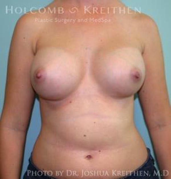 Breast Augmentation Before & After Gallery - Patient 6236592 - Image 2
