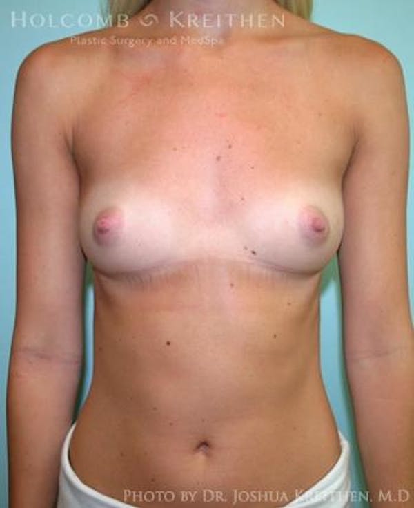 Breast Augmentation Gallery - Patient 6236593 - Image 1