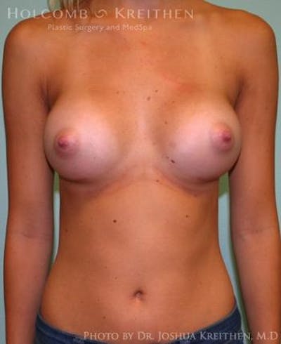 Breast Augmentation Gallery - Patient 6236593 - Image 2