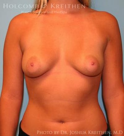 Breast Augmentation Before & After Gallery - Patient 6236594 - Image 1