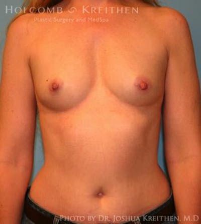 Breast Augmentation Before & After Gallery - Patient 6236595 - Image 1