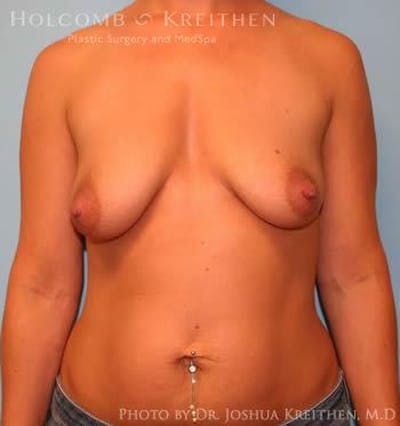 Breast Augmentation Before & After Gallery - Patient 6236597 - Image 1