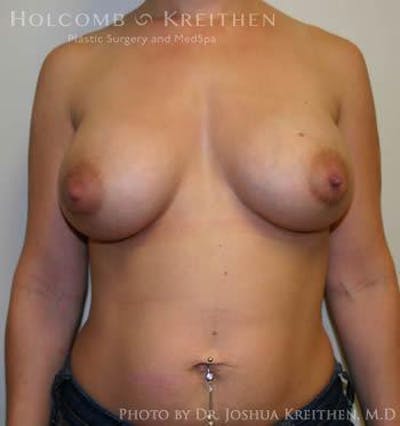 Breast Augmentation Before & After Gallery - Patient 6236597 - Image 2