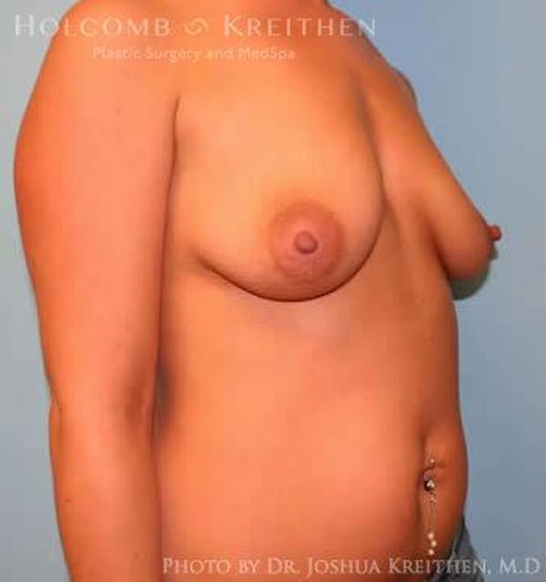 Breast Augmentation Before & After Gallery - Patient 6236597 - Image 3