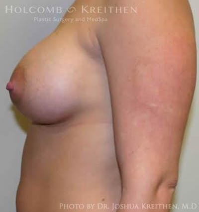 Breast Augmentation Before & After Gallery - Patient 6236597 - Image 6