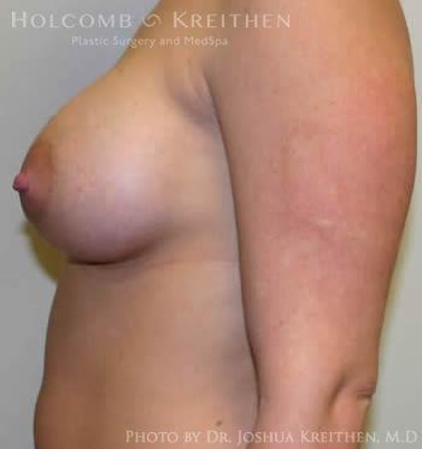 Breast Augmentation Before & After Gallery - Patient 6236597 - Image 6