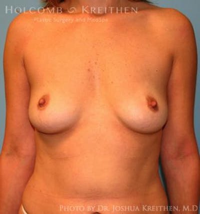Breast Augmentation Before & After Gallery - Patient 6236598 - Image 1