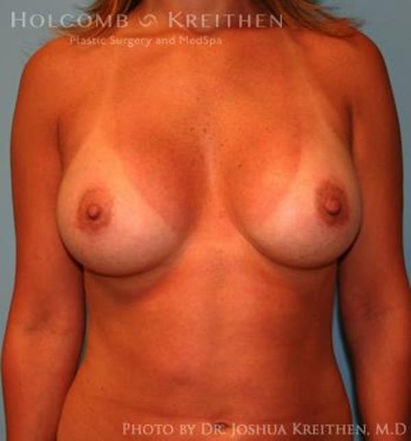 Breast Augmentation Before & After Gallery - Patient 6236598 - Image 2
