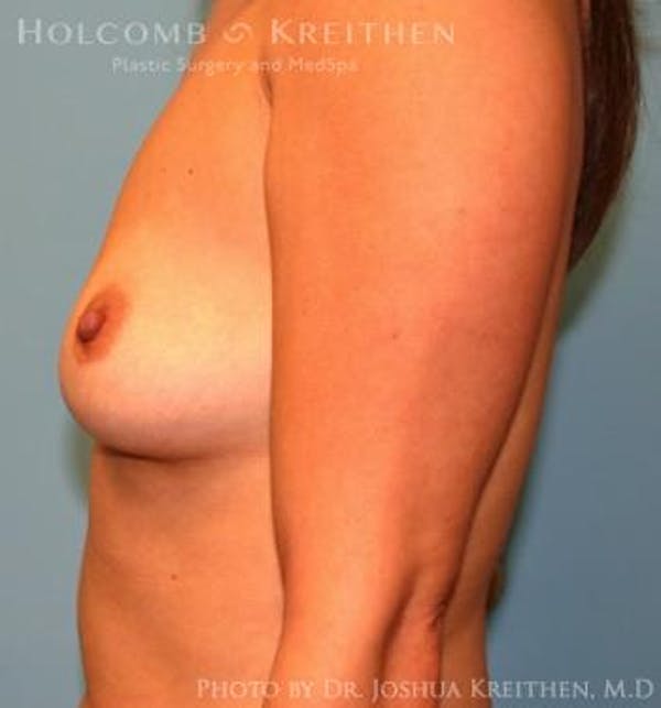 Breast Augmentation Before & After Gallery - Patient 6236598 - Image 5