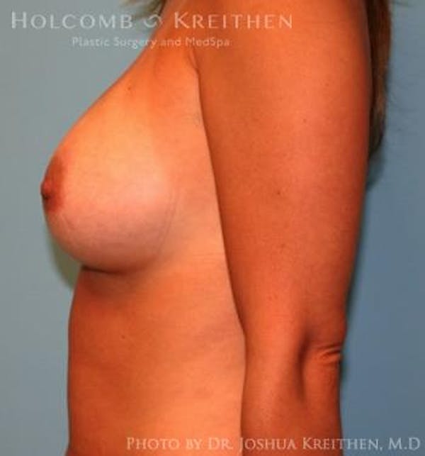 Breast Augmentation Before & After Gallery - Patient 6236598 - Image 6