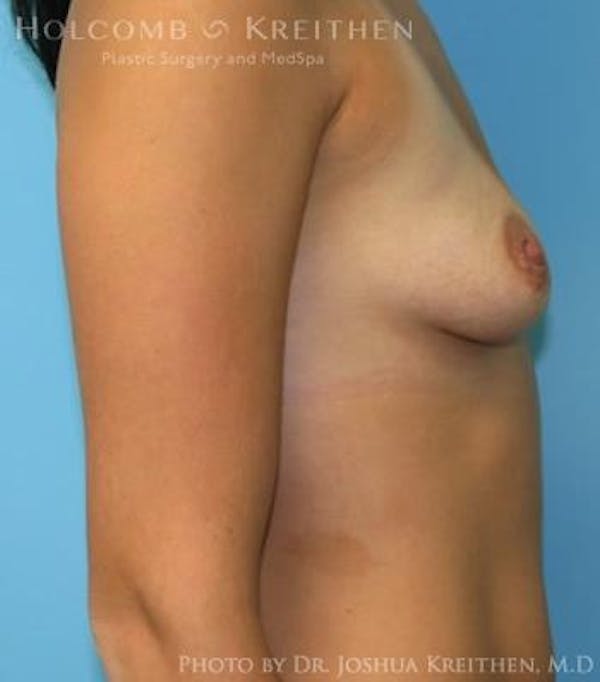Breast Augmentation Before & After Gallery - Patient 6236600 - Image 5