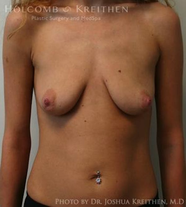 Breast Augmentation Before & After Gallery - Patient 6236601 - Image 1
