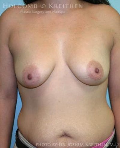Breast Augmentation Gallery - Patient 6236603 - Image 1