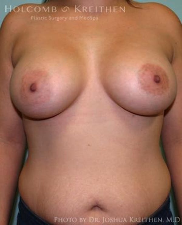 Breast Augmentation Before & After Gallery - Patient 6236603 - Image 2