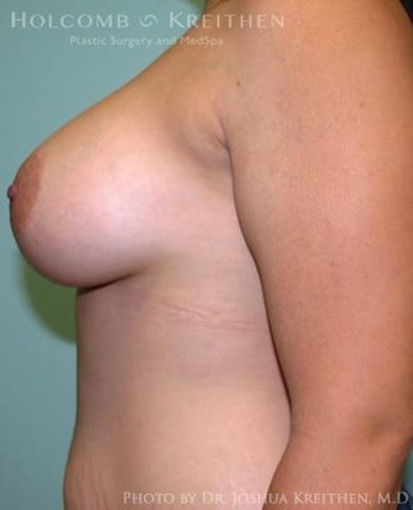 Breast Augmentation Before & After Gallery - Patient 6236603 - Image 6