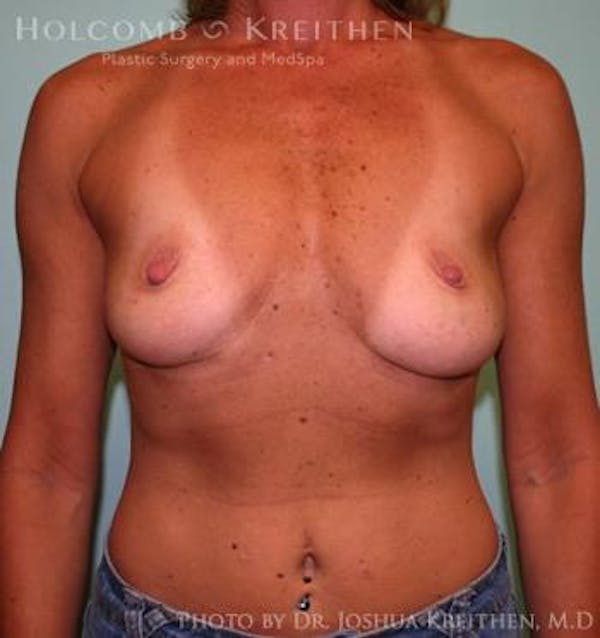 Breast Augmentation Before & After Gallery - Patient 6236606 - Image 1