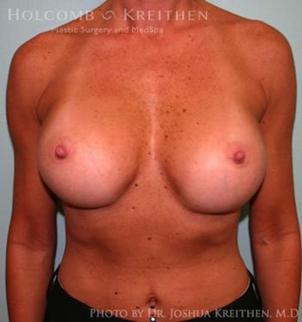 Breast Augmentation Before & After Gallery - Patient 6236606 - Image 2