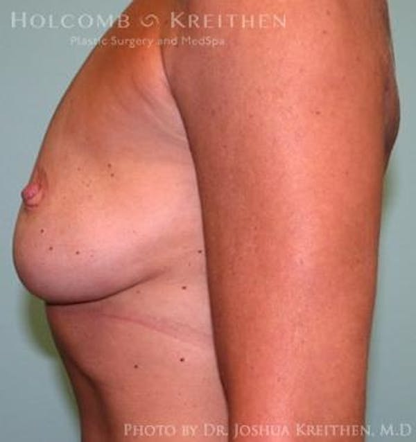 Breast Augmentation Before & After Gallery - Patient 6236606 - Image 5