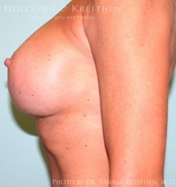 Breast Augmentation Before & After Gallery - Patient 6236606 - Image 6