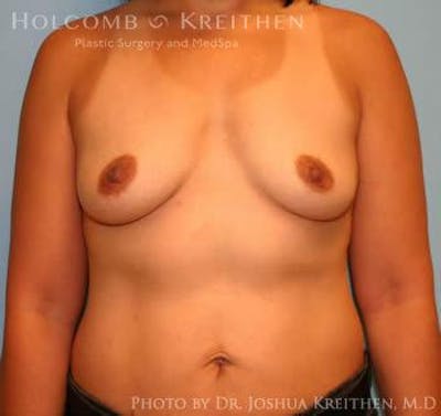 Breast Augmentation Before & After Gallery - Patient 6236608 - Image 1